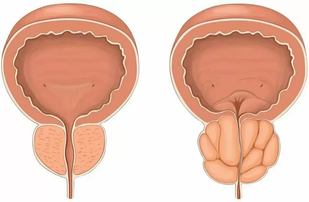Prostatitis és agy)